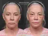 Revision Deep Plane Facelift Package in Seoul, South Korea by Dr. Minhee Ryu at RNWOOD