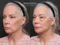 Revision Deep Plane Facelift Package in Seoul, South Korea by Dr. Minhee Ryu at RNWOOD