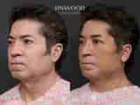 Deep Plane Face Lift, Deep Neck Lift, and Fat Graft Package in South Korea by RNWOOD Seoul