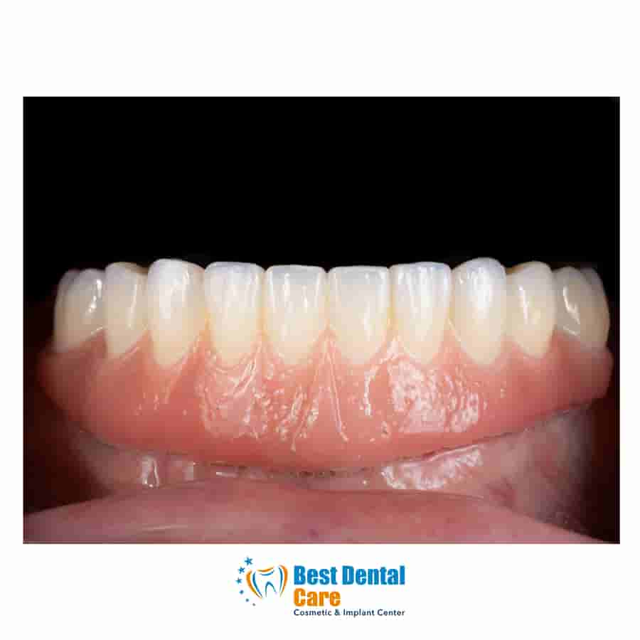 35% OFF Full-Arch Dental Treatments â€“ Limited-Time Promotion