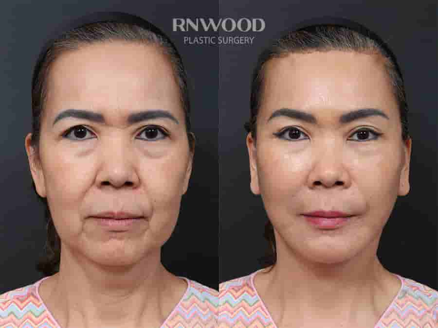 Deep Plane Face Lift, Deep Neck Lift, and Fat Graft Package in South Korea by RNWOOD Seoul