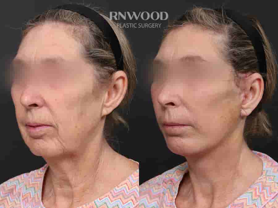 Deep Plane Face Lift, Deep Neck Lift, and Fat Graft Package in South Korea by RNWOOD Seoul