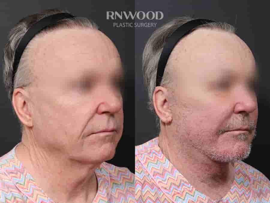Deep Plane Face Lift, Deep Neck Lift, and Fat Graft Package in South Korea by RNWOOD Seoul