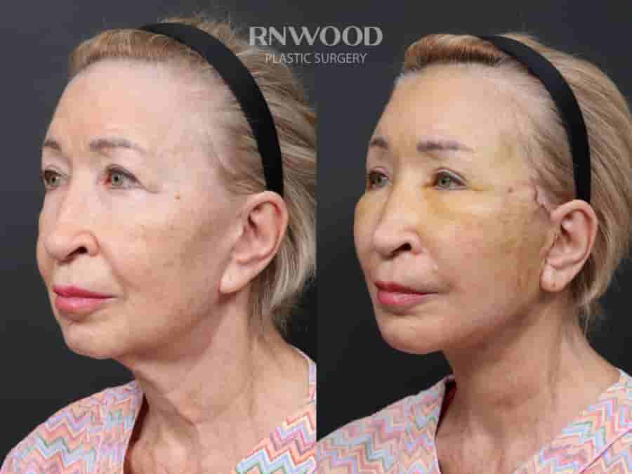 Revision Deep Plane Facelift Package in Seoul, South Korea by Dr. Minhee Ryu at RNWOOD