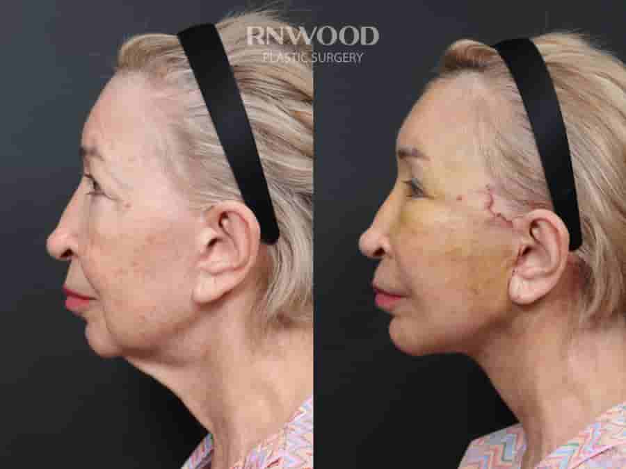 Revision Deep Plane Facelift Package in Seoul, South Korea by Dr. Minhee Ryu at RNWOOD