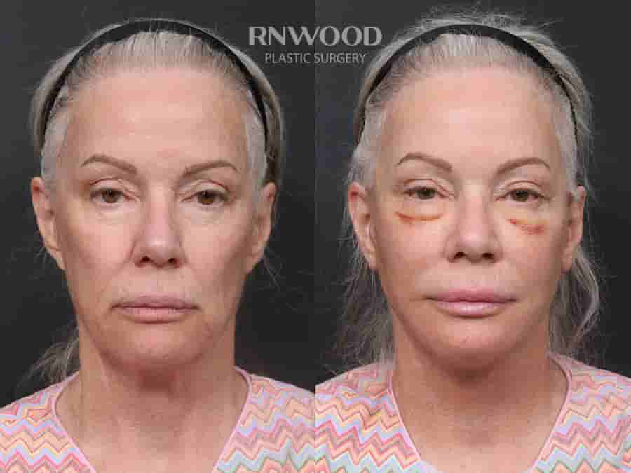 Revision Deep Plane Facelift Package in Seoul, South Korea by Dr. Minhee Ryu at RNWOOD