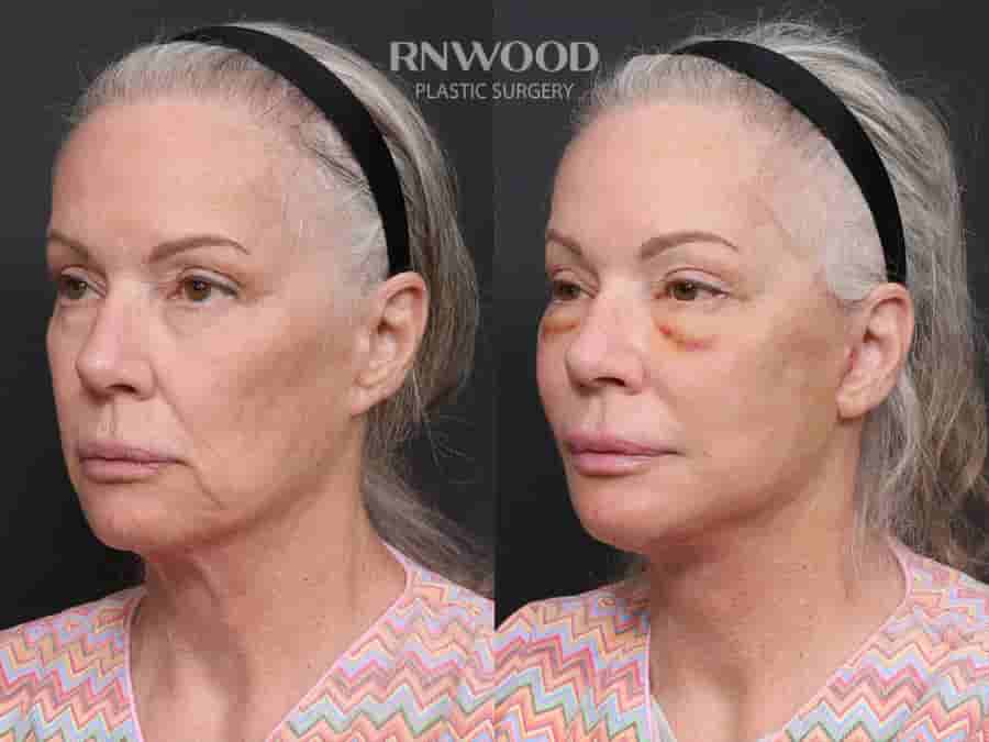 Revision Deep Plane Facelift Package in Seoul, South Korea by Dr. Minhee Ryu at RNWOOD