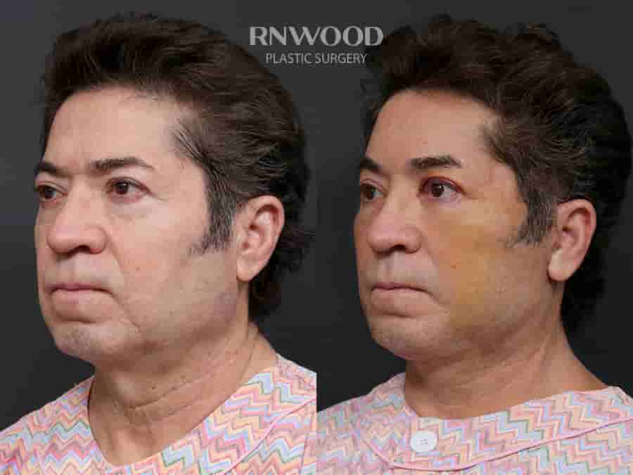 Deep Plane Face Lift, Deep Neck Lift, and Fat Graft Package in South Korea by RNWOOD Seoul