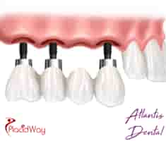Atlantis Dental, Esthetic and Implant Dentistry Reviews in San Jose, Costa Rica Slider image 9