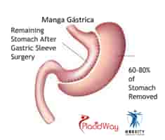 Obesity Surgical Center Reviews in Tijuana, Mexico From Bariatric Patients Slider image 4