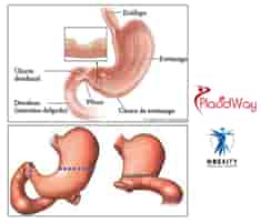 Obesity Surgical Center Reviews in Tijuana, Mexico From Bariatric Patients Slider image 5