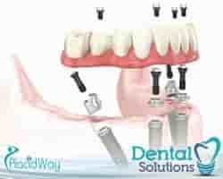 Dental Solutions Los Algodones Reviews From Dental Patients in Algodones, Mexico Slider image 3