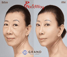 Grand Plastic Surgery in Seoul, South Korea Reviews from Real Patients Slider image 3
