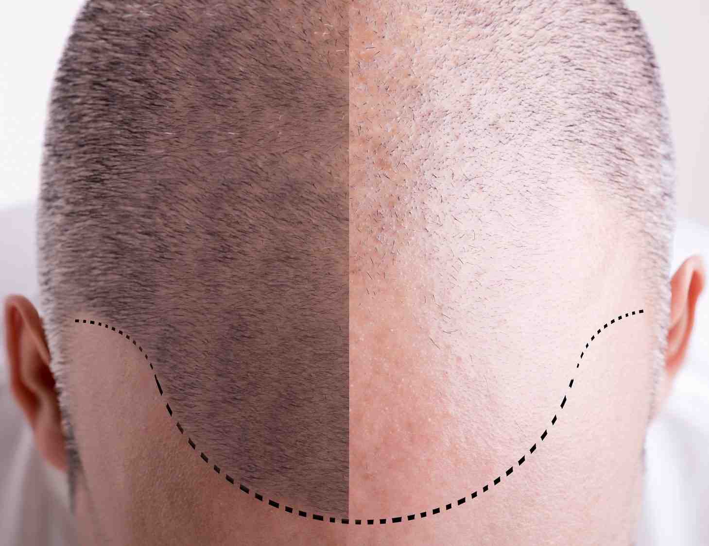 Verified Patient Reviews of CAPMED (Hair Transplant and Aesthetic Medicine) in Santiago de los Caballeros, Dominican Republic Slider image 4