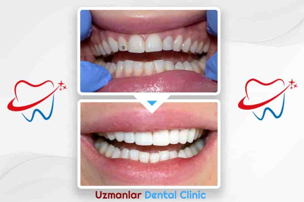 Uzmanlar Dental Clinic Reviews in Istanbul, Turkey Slider image 9
