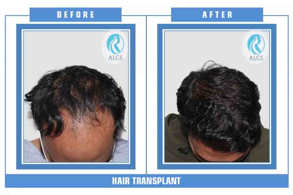 ALCS - Hair Transplant &  Cosmetic Clinic in Jaipur, India Reviews from Real Patients Slider image 2