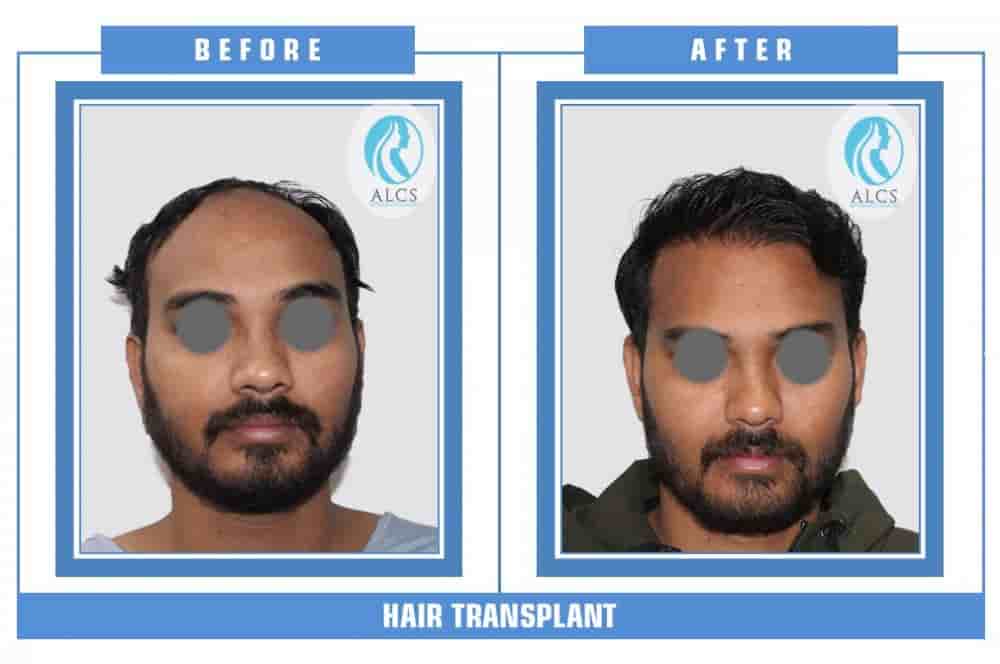 ALCS - Hair Transplant &  Cosmetic Clinic in Jaipur, India Reviews from Real Patients Slider image 4
