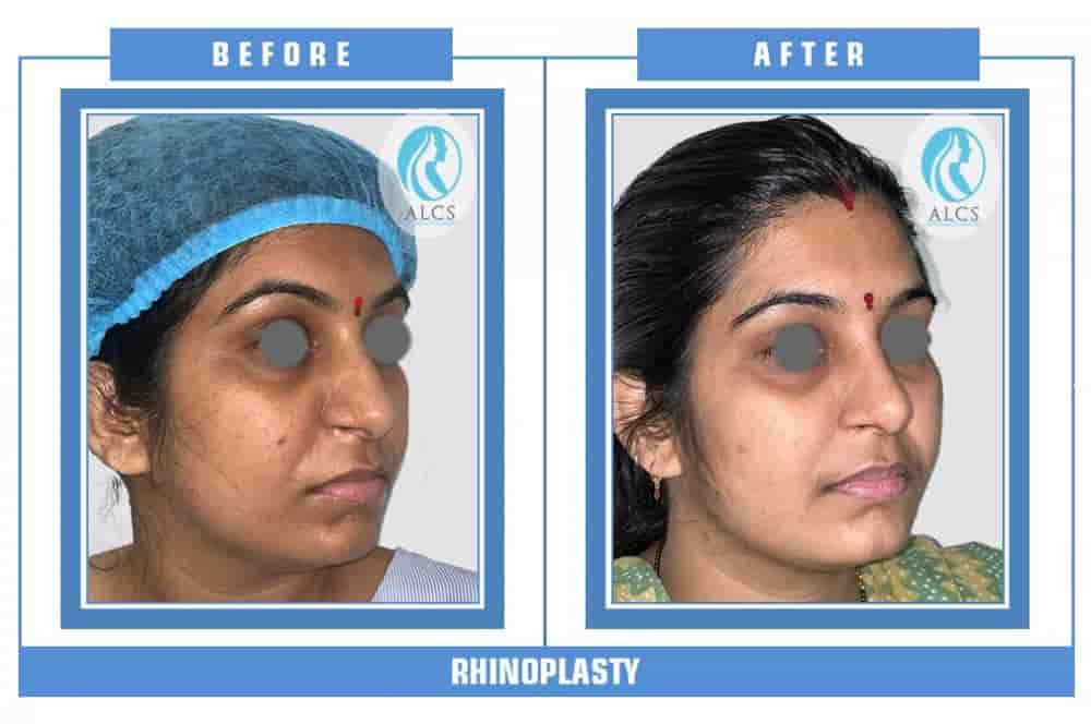 ALCS - Hair Transplant &  Cosmetic Clinic in Jaipur, India Reviews from Real Patients Slider image 5