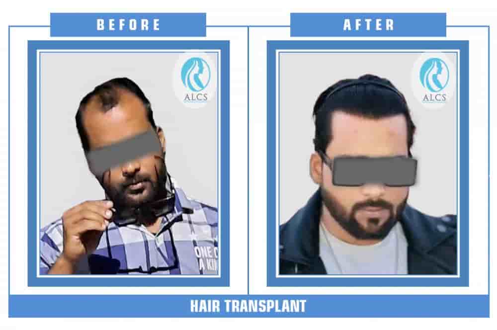 ALCS - Hair Transplant &  Cosmetic Clinic in Jaipur, India Reviews from Real Patients Slider image 6