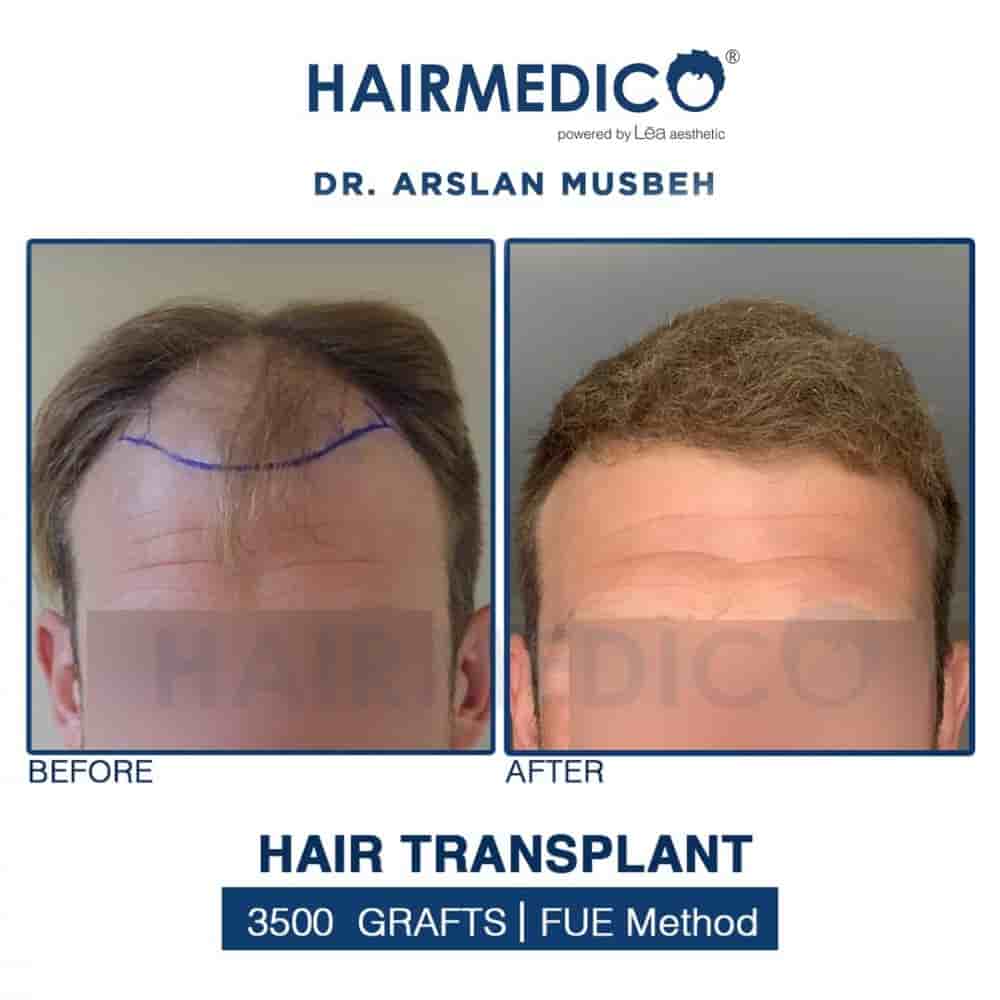 Hairmedico in Istanbul, Turkey Reviews from Real Patients Slider image 1