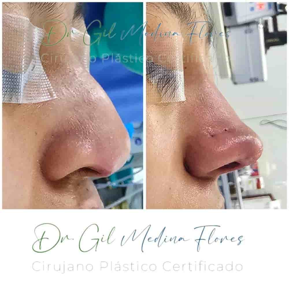 Medina Flores Plastic Surgery in Merida, Mexico Reviews from Real Patients Slider image 7