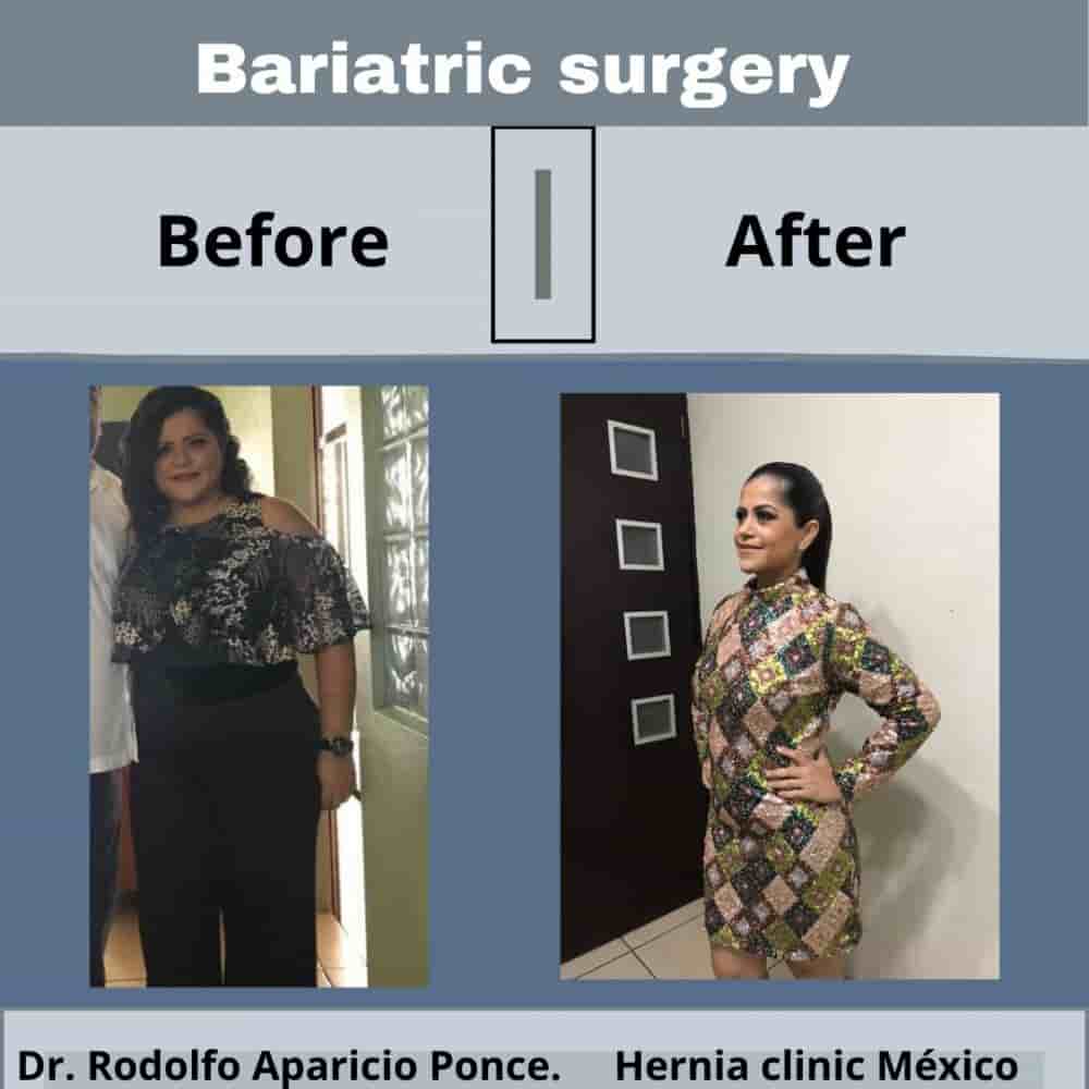 Hernia Clinic Mexico and Bariatric Center Reviews in Merida, Mexico Slider image 4