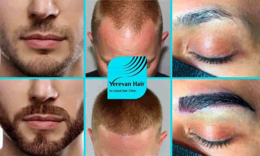 United Hair Clinic Reviews in Yerevan, Armenia From Vertified Hair Treatment Patients  Slider image 1
