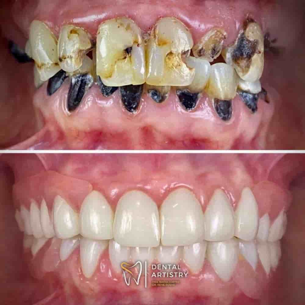 Dental Artistry & World Dental Center in Nuevo Progreso, Mexico Reviews from Real Patients Slider image 4