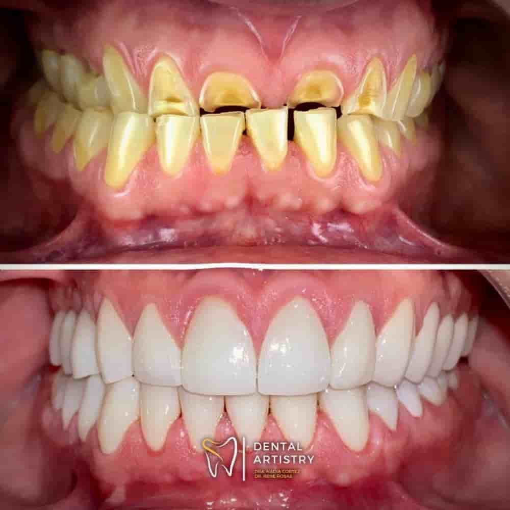 Dental Artistry & World Dental Center in Nuevo Progreso, Mexico Reviews from Real Patients Slider image 7