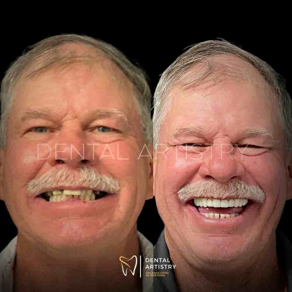 Dental Artistry & World Dental Center in Nuevo Progreso, Mexico Reviews from Real Patients Slider image 8