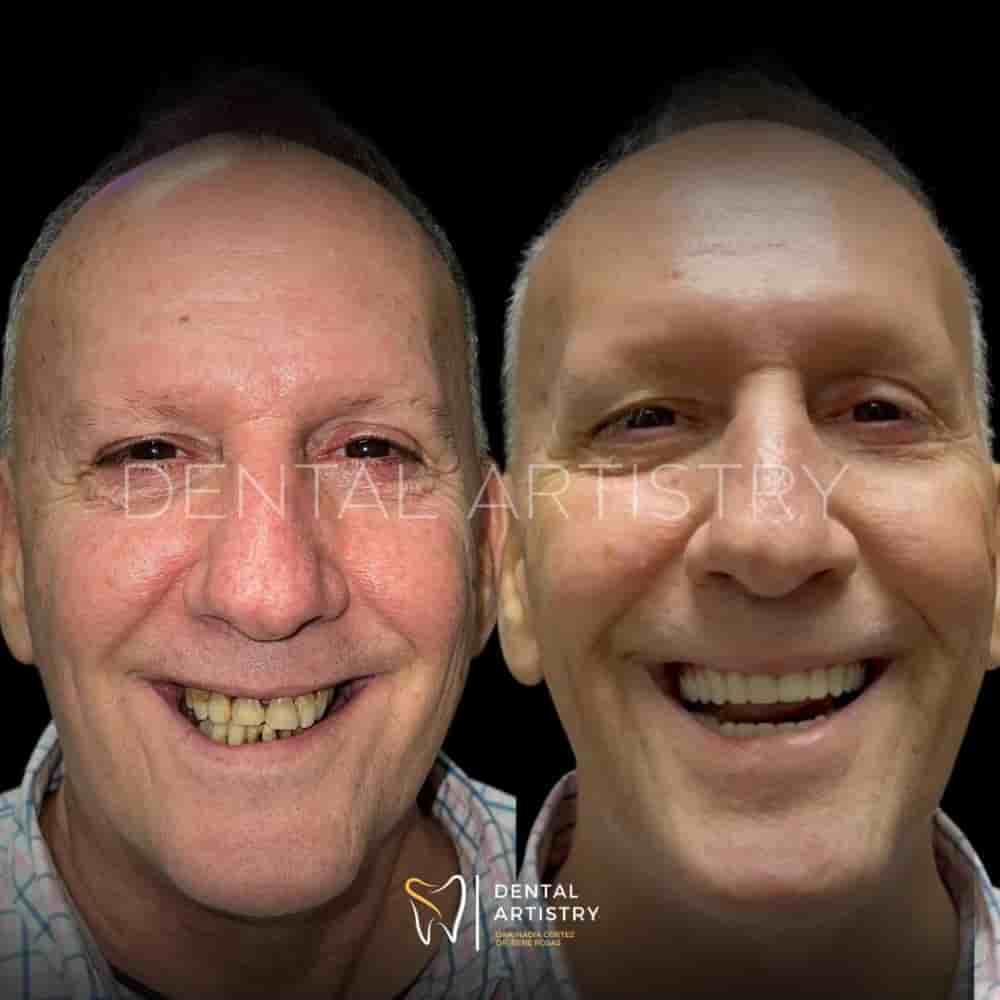 Dental Artistry & World Dental Center in Nuevo Progreso, Mexico Reviews from Real Patients Slider image 9