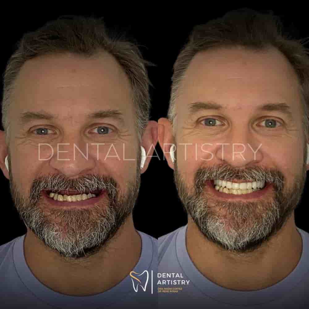 Dental Artistry & World Dental Center in Nuevo Progreso, Mexico Reviews from Real Patients Slider image 10