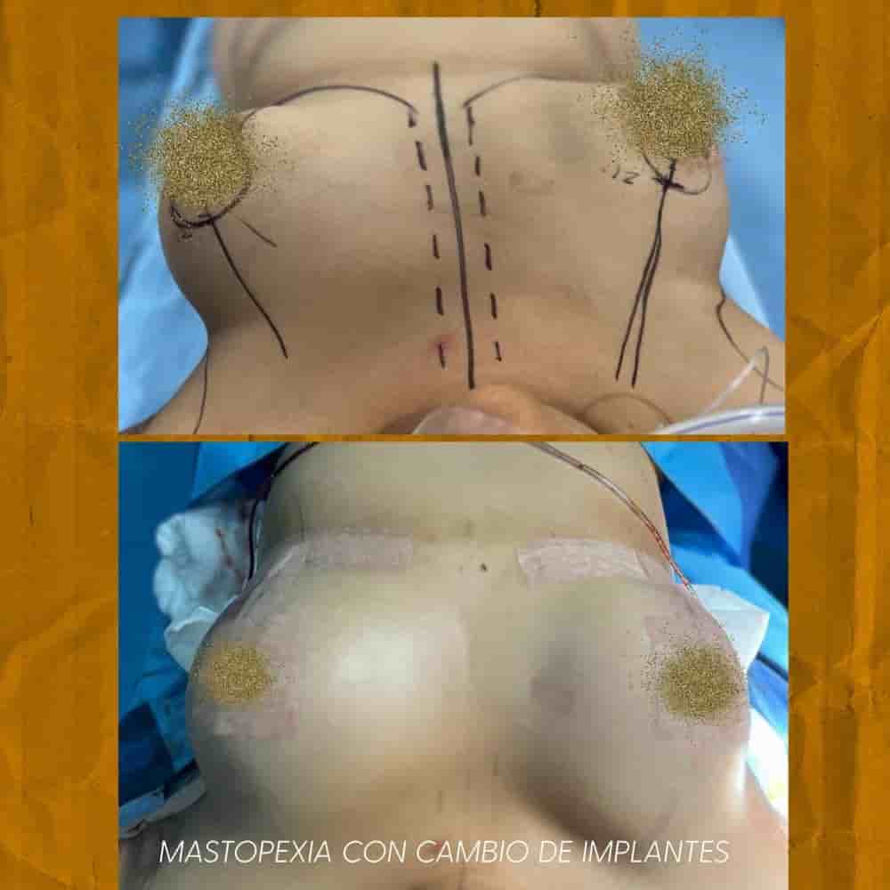 Dr. Eduardo Cartagena in Mexico City, Mexico Reviews From Aesthetic Surgery Patients Slider image 3