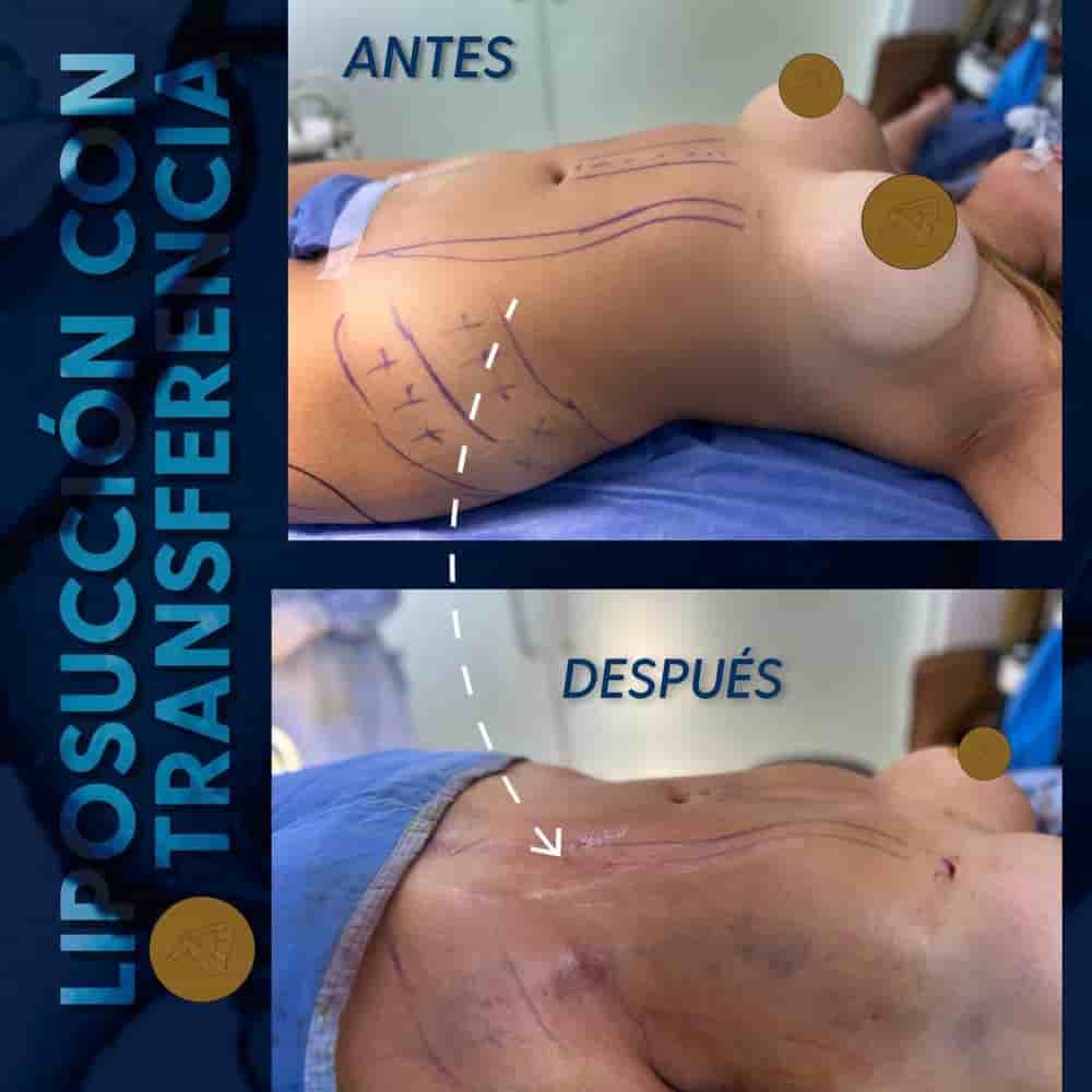 Dr. Eduardo Cartagena in Mexico City, Mexico Reviews From Aesthetic Surgery Patients Slider image 4