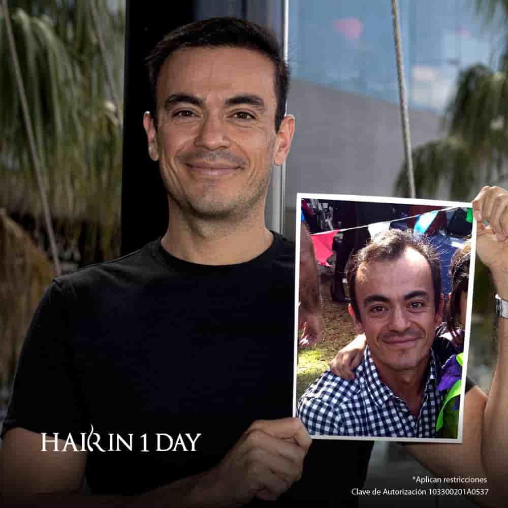 Hair in 1 Day - Hair Transplant Clinic Reviews in Monterrey,Guadalajara,Ciudad de Mexico, Mexico Slider image 1