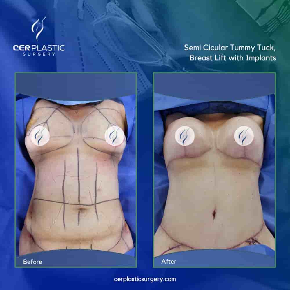 CER Hospital Reviews in Tijuana Mexico from Real Bariatric & Aesthetic Patients  Slider image 7