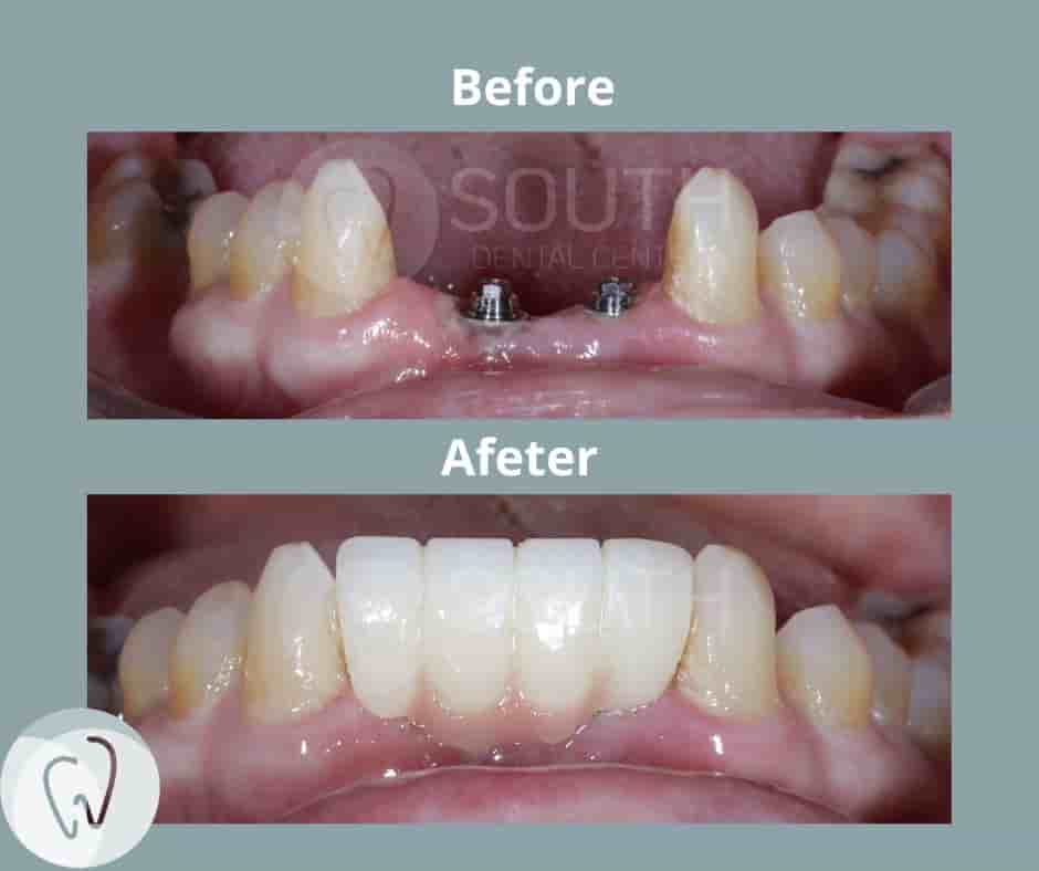 South Dental Center in Los Algodones, Mexico Reviews from Real Patients Slider image 1