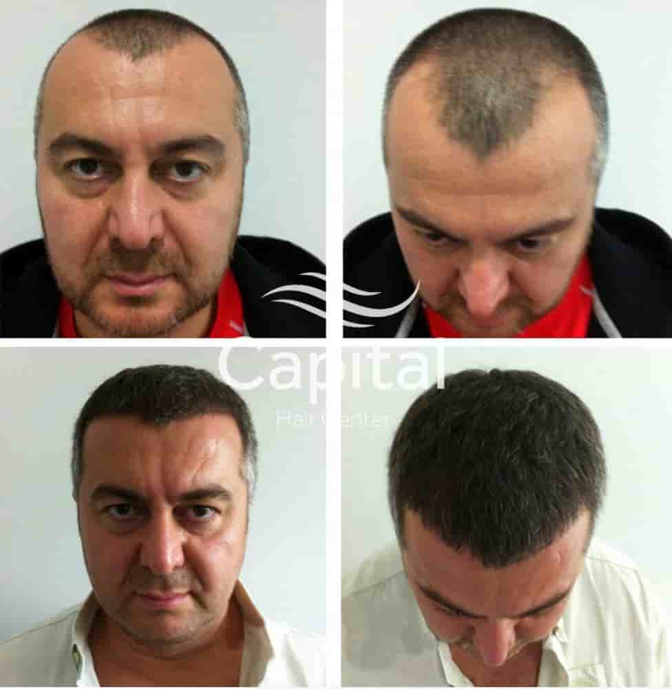 Capital Hair Center Reviews in Istanbul, Turkey by Hair Transplant Patients Slider image 8