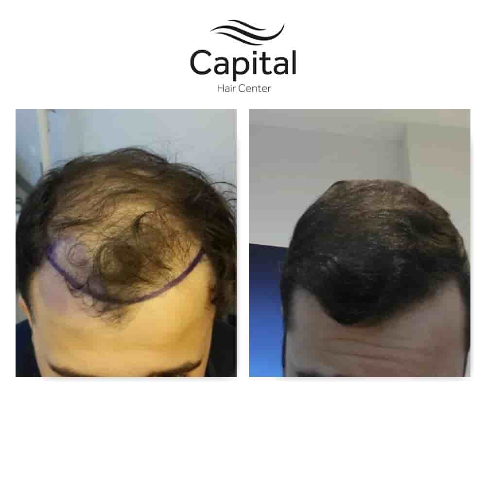 Capital Hair Center Reviews in Istanbul, Turkey by Hair Transplant Patients Slider image 10