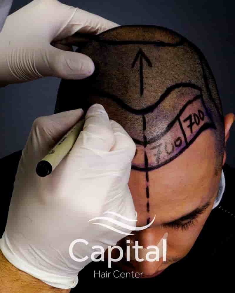 Capital Hair Center Reviews in Istanbul, Turkey by Hair Transplant Patients Slider image 7