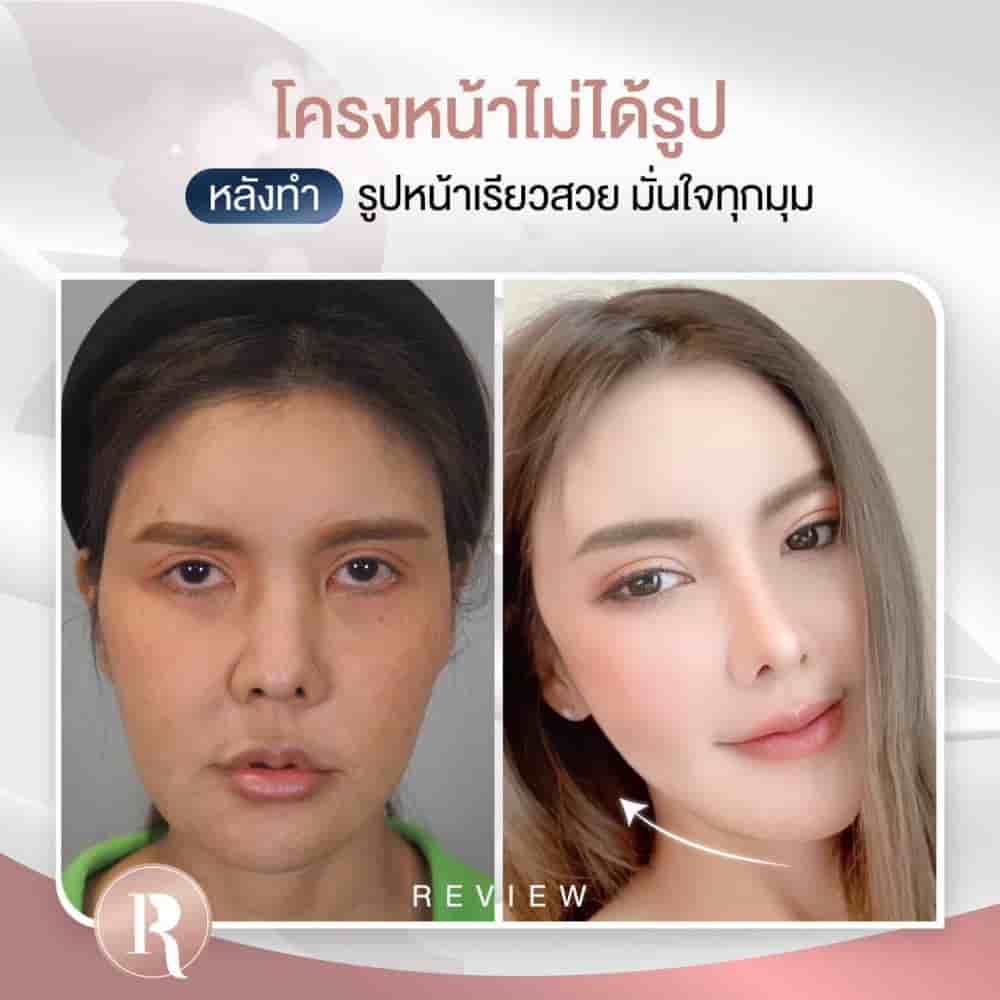 Reals Aesthetic Center in Bangkok, Thailand Reviews from Real Patients Slider image 1