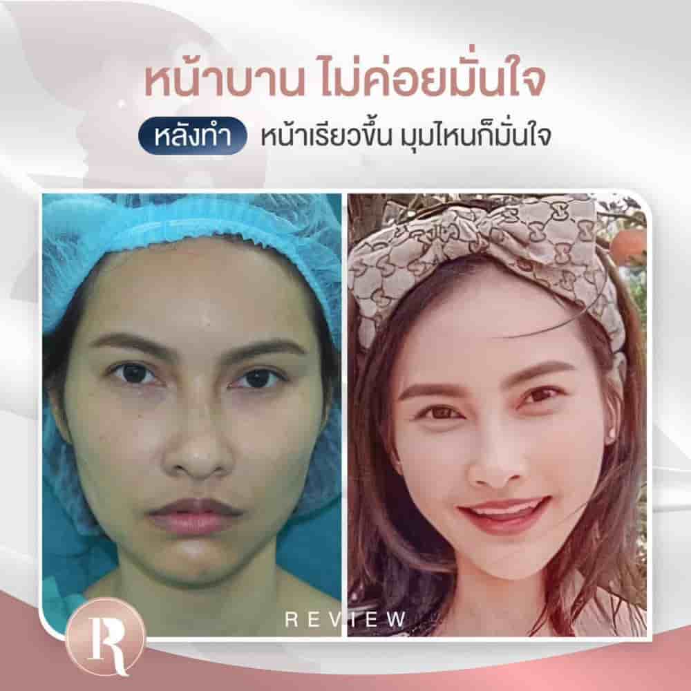 Reals Aesthetic Center in Bangkok, Thailand Reviews from Real Patients Slider image 2
