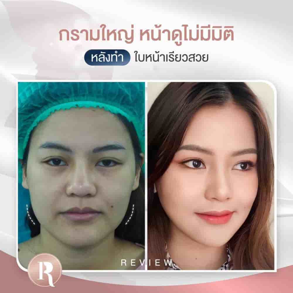 Reals Aesthetic Center in Bangkok, Thailand Reviews from Real Patients Slider image 3