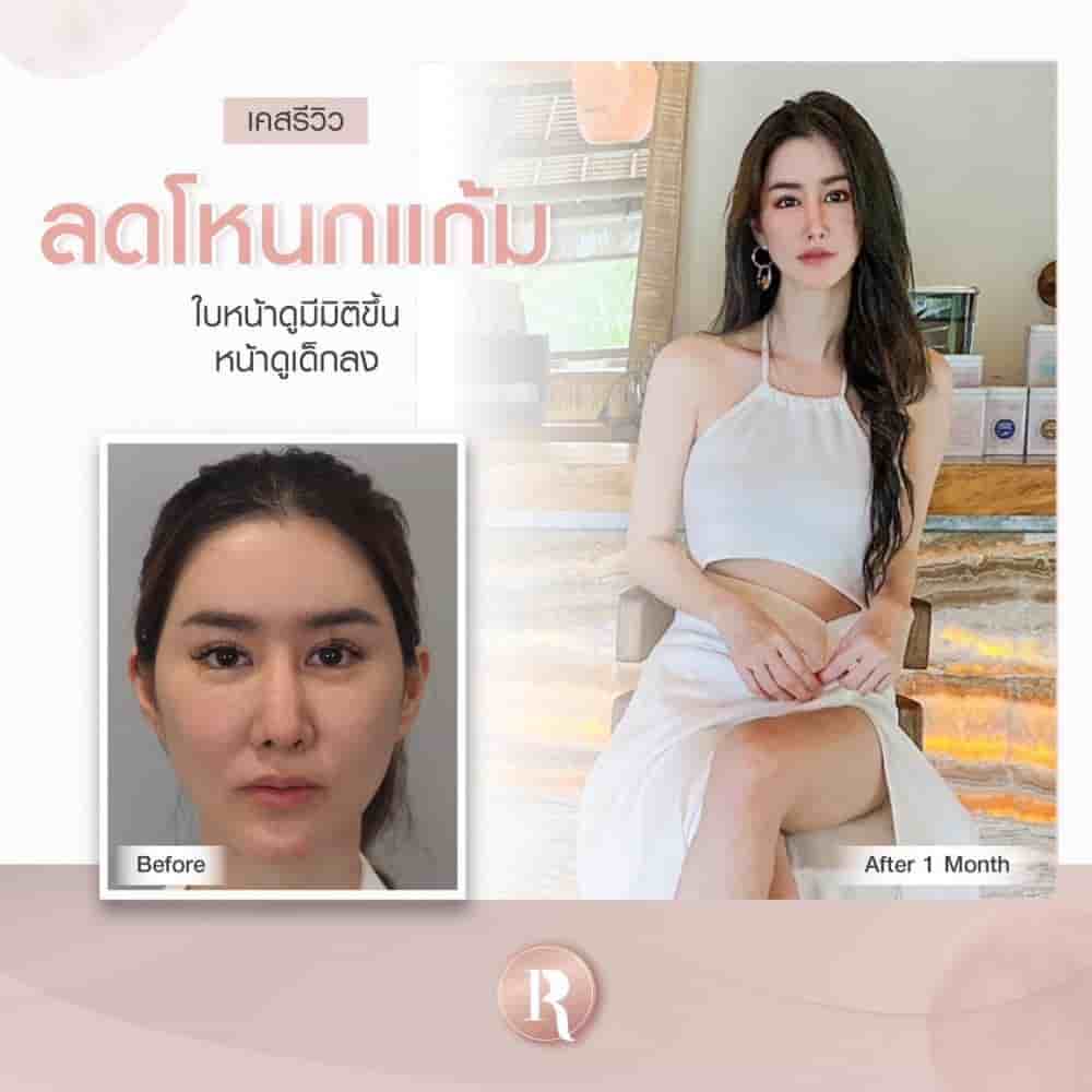 Reals Aesthetic Center in Bangkok, Thailand Reviews from Real Patients Slider image 9