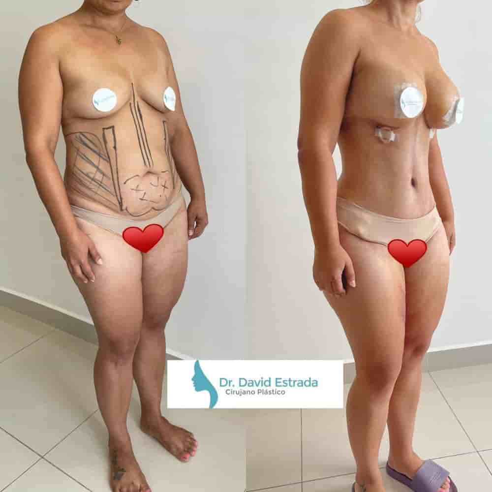 Dr. David Estradaa Clinic in Cancun, Mexico Reviews From Cosmetic Surgery Patients Slider image 6