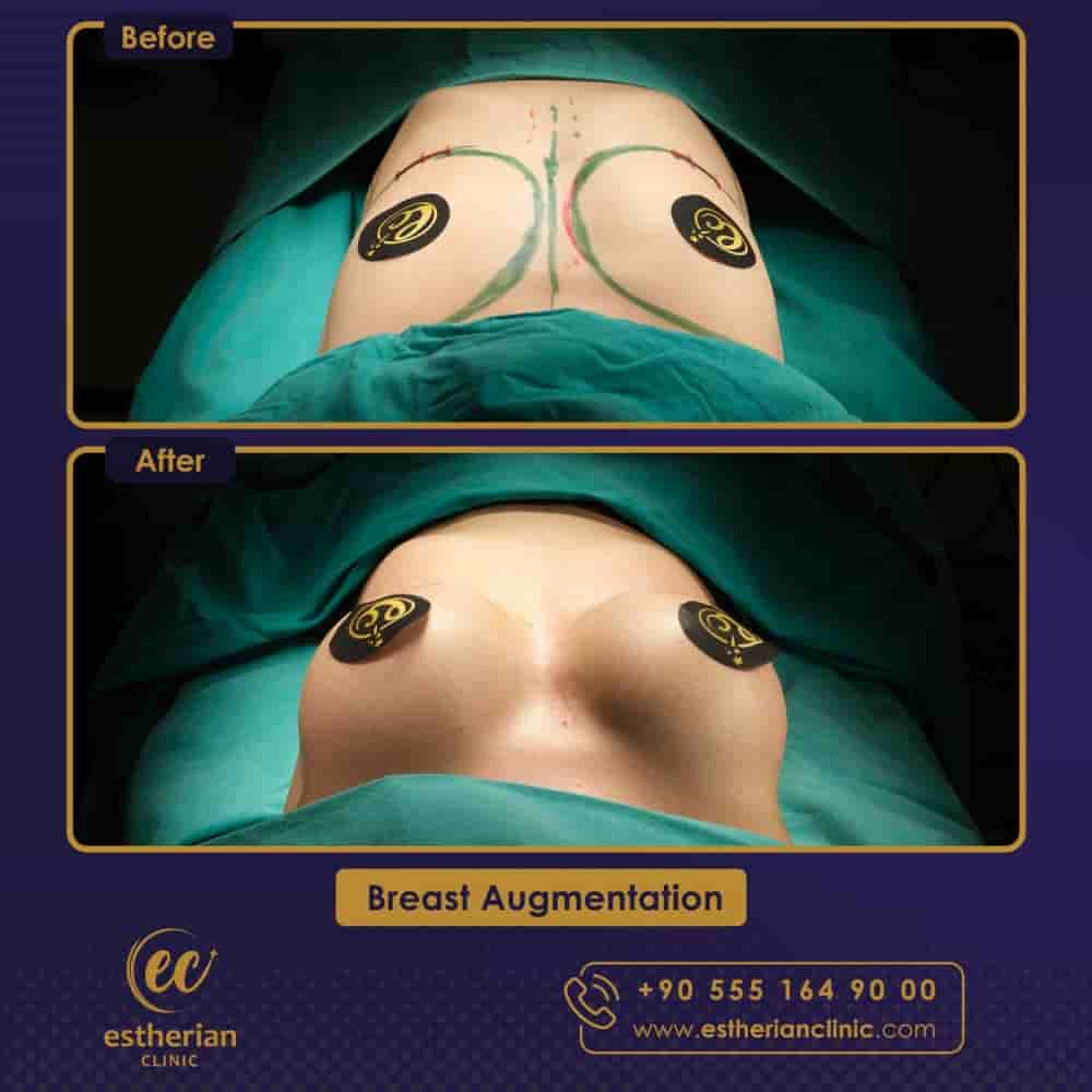 Estherian Clinic in Istanbul Turkey Reviews From Real Plastic Surgery Patients Slider image 9