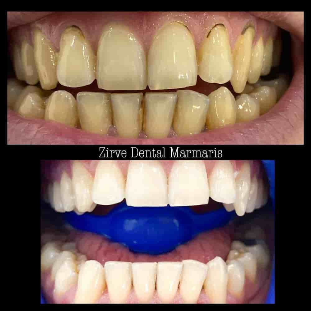Zirve Dental Marmaris in Marmaris, Turkey Reviews from Real Patients Slider image 3