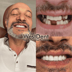 WestDent Clinic Turkey in Izmir, Turkey Reviews from Real Patients Slider image 4