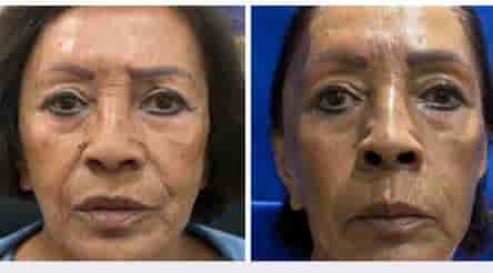 Aesthetic and Oncologic Face, Head and Neck Clinic and OR in Tijuana, Mexico Reviews from Real Patients Slider image 3