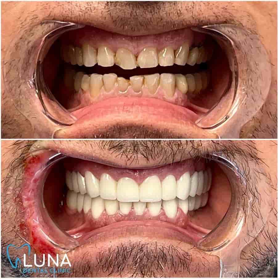 Luna Dental Clinic in Tirana, Albania Reviews from Real Patients Slider image 6